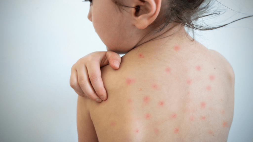 Child with chickenpox in Bedford